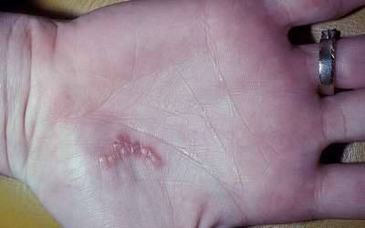 Герпес на ладонях