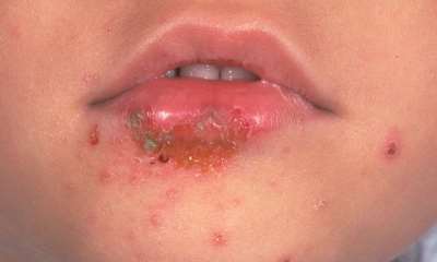 Герпес на лице у ребенка