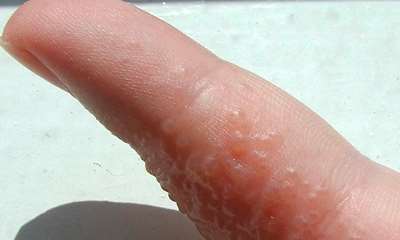 Герпес на пальцах рук