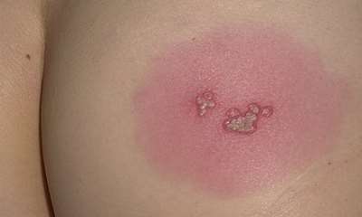 Герпес на попе у ребенка