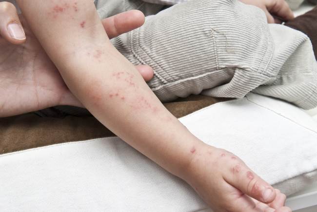 Герпес на руках