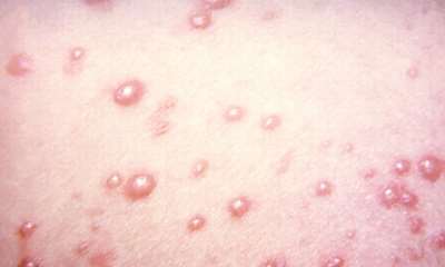 Герпес на теле у ребенка