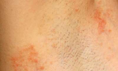 Герпес под мышкой