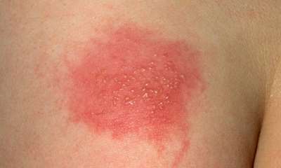 Герпес у грудничка