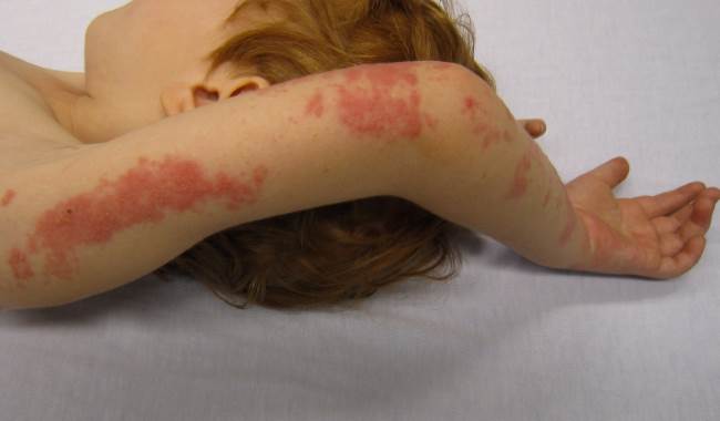 Герпес у детей