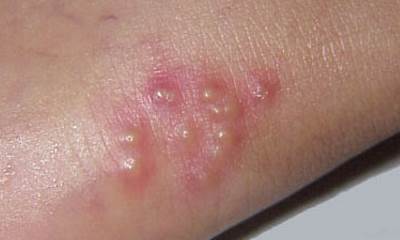 Как начинается герпес у детей