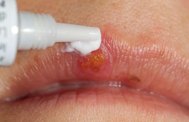 Лечение простуды на лице и губах