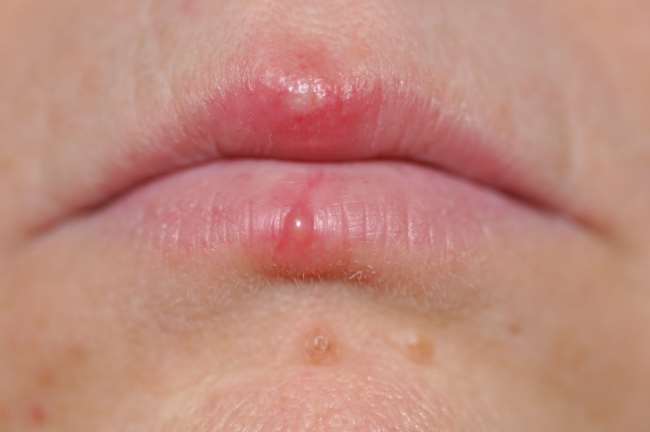 Простуда на губах