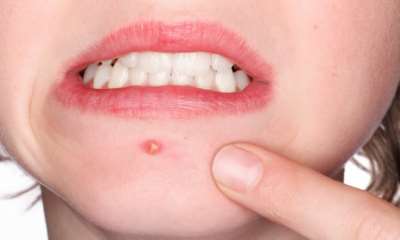 Простуда на лице