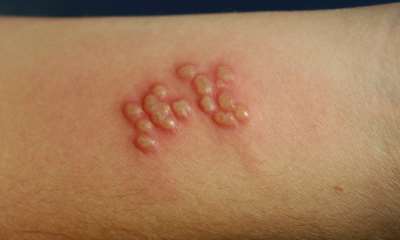 Простуда на руках