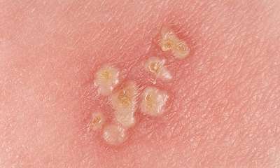 Простуда на теле