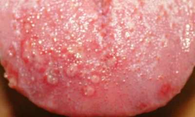 Простуда на языке