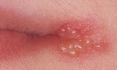 Простудные прыщи