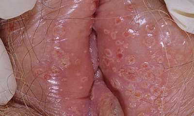 Вагинальный герпес