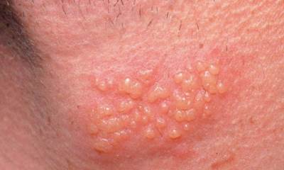 Генитальный герпес у женщин