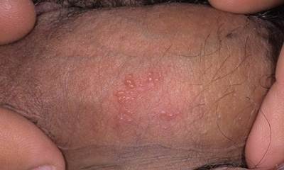 Генитальный герпес у мужчин