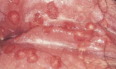 Герпес во влагалище