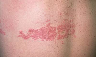 Герпес зостер