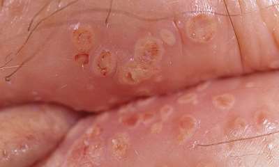 Герпес на половой губе