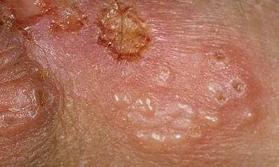 Герпес на половых органах у женщин