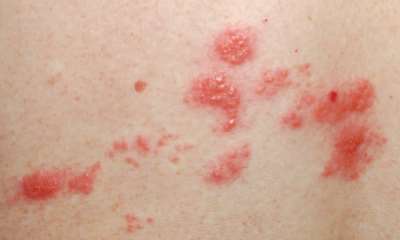 Как выглядит герпес на теле