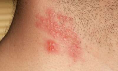 Как выглядит герпес на шее