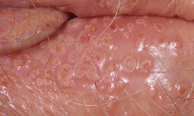 Герпес на гениталиях