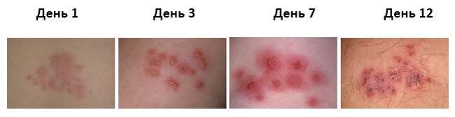 Начальная стадия опоясывающего герпеса