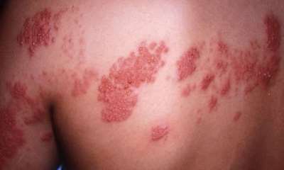 Опоясывающий герпес у детей