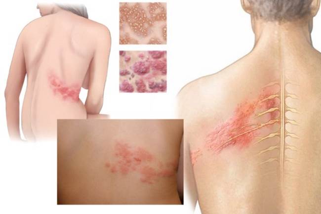 Опоясывающий герпес