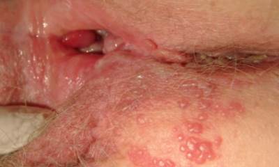 Половой герпес у женщин