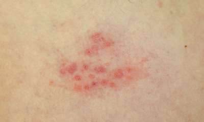 Симптомы герпеса на теле