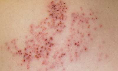 Симптомы опоясывающего герпеса