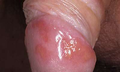 Герпес на головке у мужчин