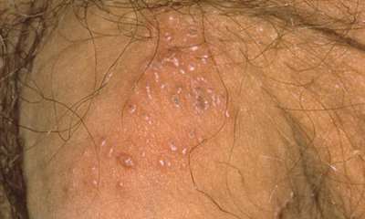 Герпес на мужском органе