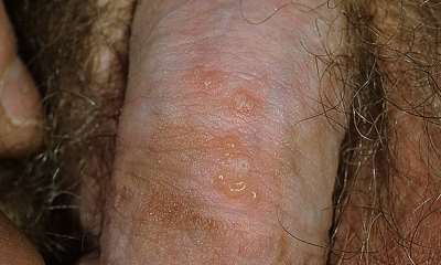 Герпес на половом члене