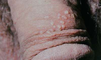 Половой герпес у мужчин