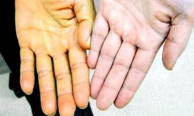 Признаки гепатита С у мужчин