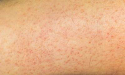 Сыпь при гепатите С