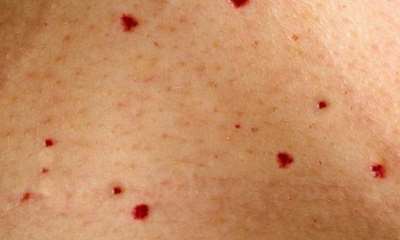 Сыпь при панкреатите