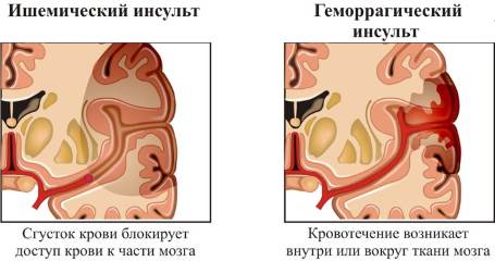 Геморрагический инсульт