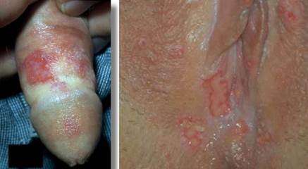 Герпес на половых органах