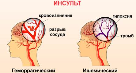 Ишемический инсульт головного мозга