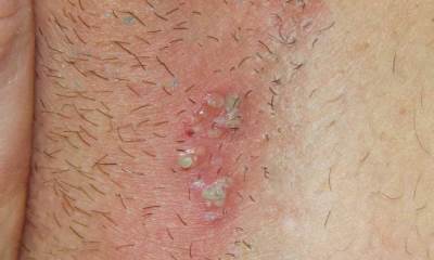 Половой герпес у женщин