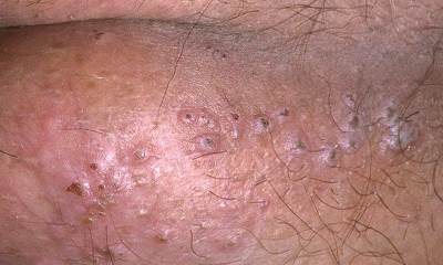 Половой герпес у мужчин