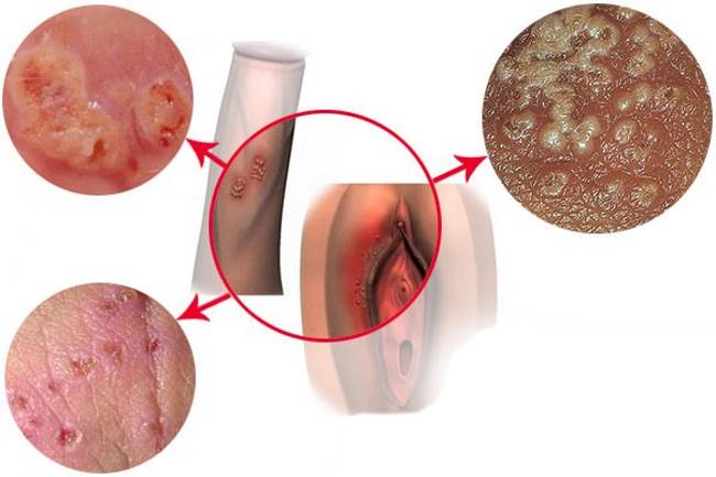 Половой герпес