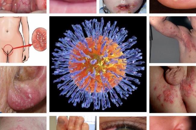 Виды герпеса на теле