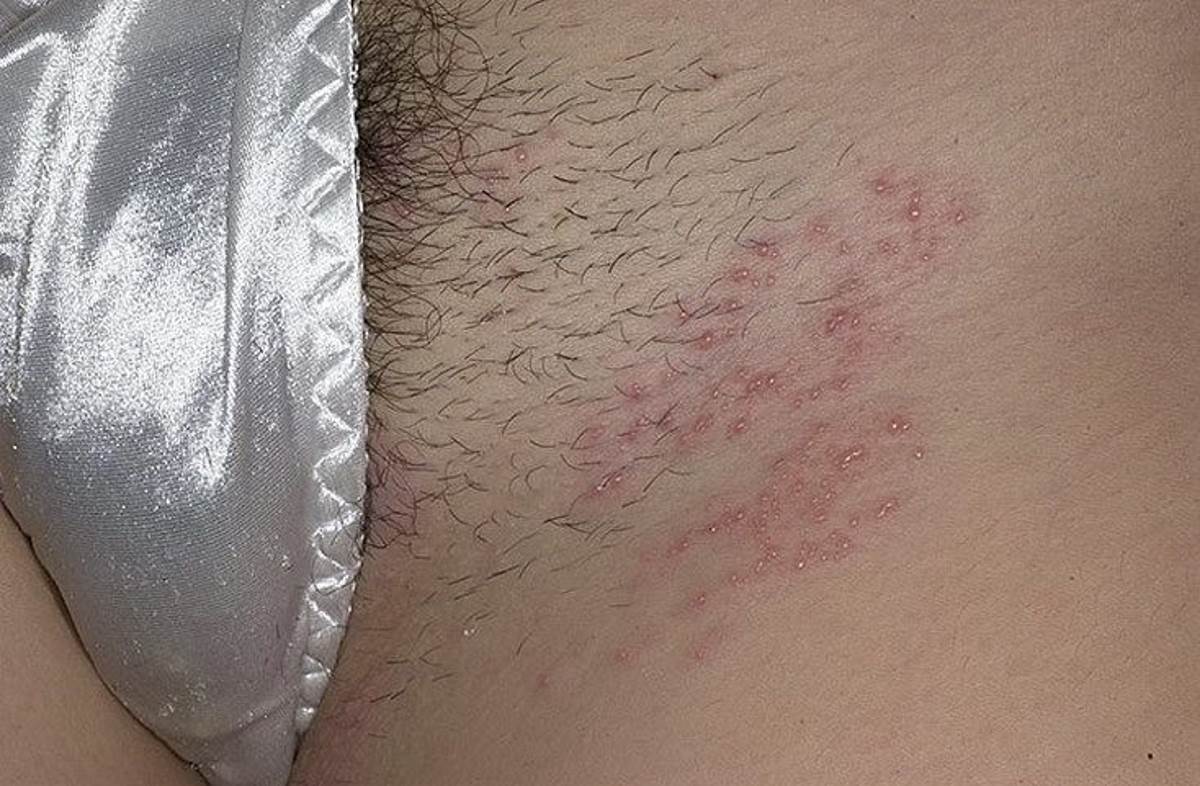 Герпес в интимной зоне у женщин