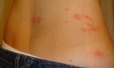 Герпес на пояснице