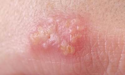 Лабиальный герпес